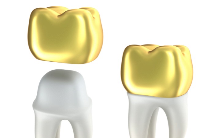 Diagnopein Dental Crowns